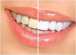 Teeth Whitening North Sydney Waverton Neutral Bay Mosman